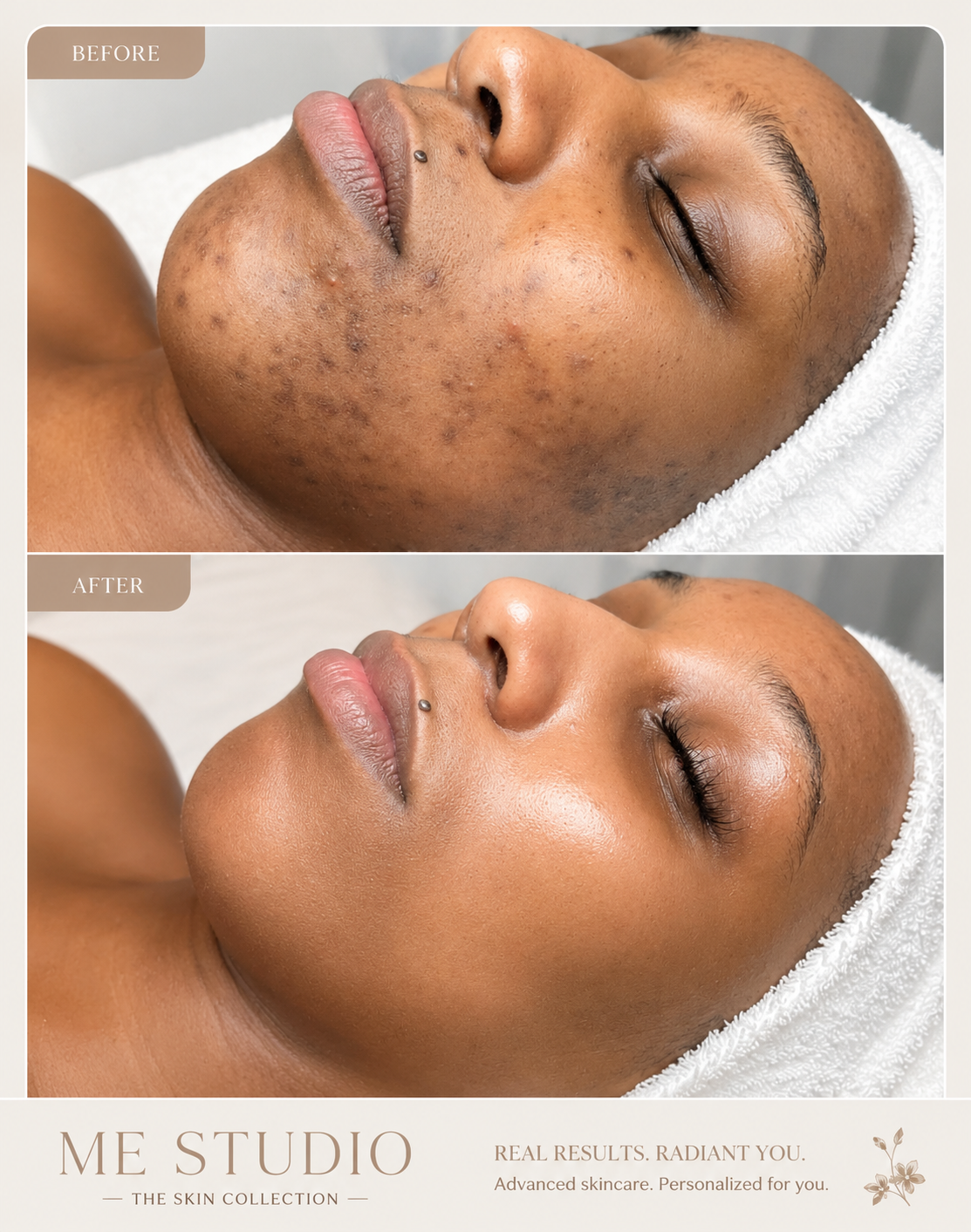 Before and after of post-inflammatory hyperpigmentation with Cosmelan®