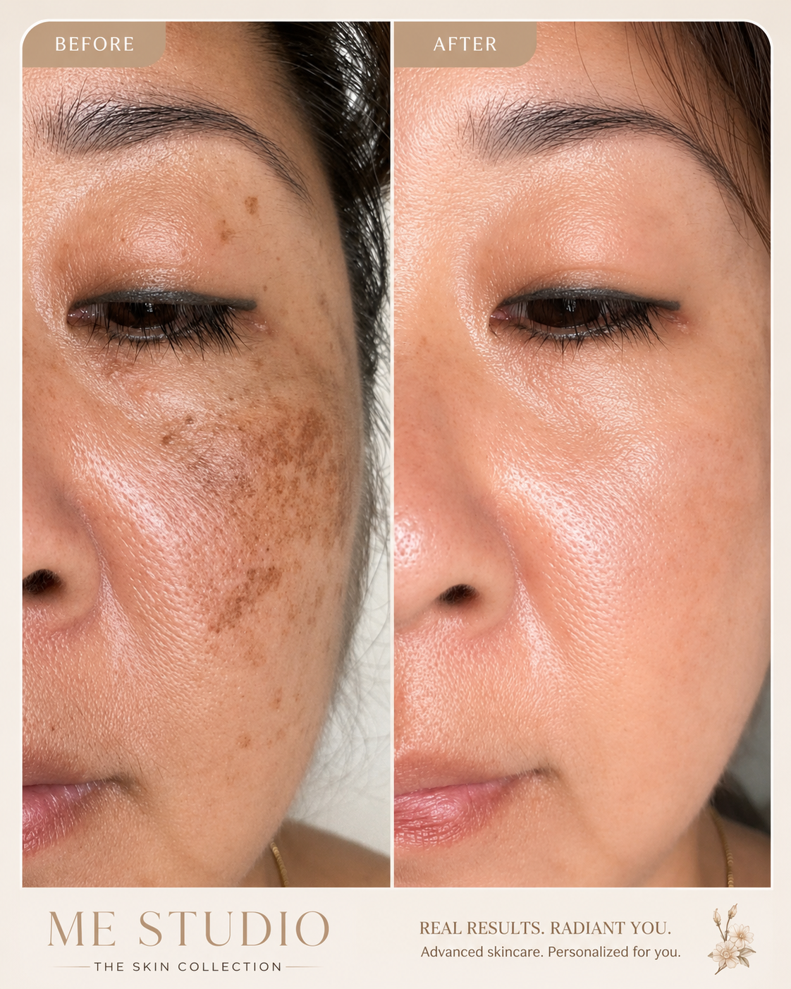 Cosmelan® protocol before and after on facial melasma