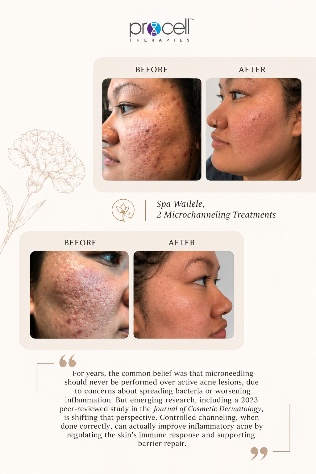 ProCell Microchanneling — official before and after